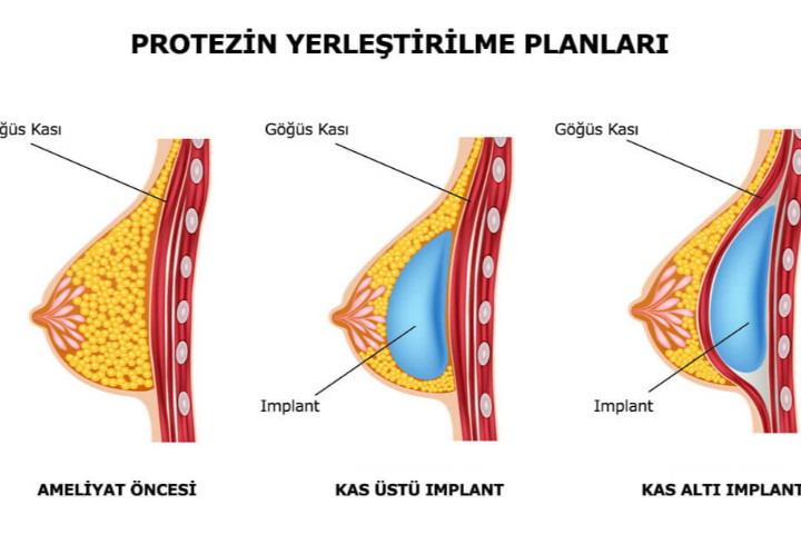 Meme Büyütme