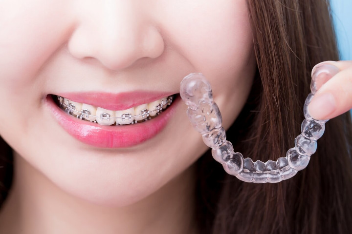 Diş Şeffaf Plak Tedavisi - Invisalign