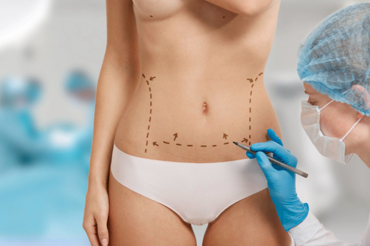 Liposuction - Yağ Aldırma Operasyonu